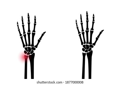 X ray of arm fracture with red pain point and normal arm. Broken hand with Inner closed greenstick distal type of fracture. Human skeleton anatomy concept. Medical banner. Flat vector illustration.