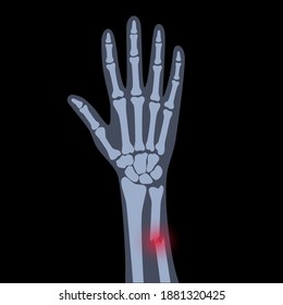 X ray of arm fracture with red pain point and inflammination. Broken hand with Inner closed greenstick type of fracture. Human skeleton anatomy concept. Medical banner. Flat vector illustration.
