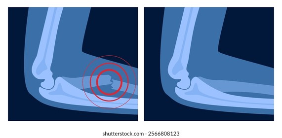 X ray of arm fracture with red pain point. Broken hand with open type of fracture. Human skeleton anatomy concept. Medical banner for clinic or hospital. Vector