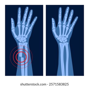 X ray of arm fracture with red pain point. Broken hand with open type of fracture. Human skeleton anatomy concept. Medical banner for clinic or hospital. Vector