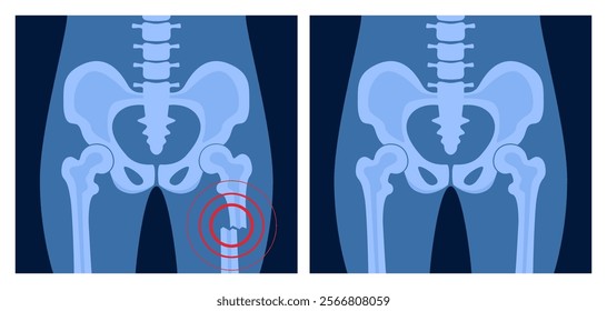 X ray of femur fracture with red pain point. Broken leg with open type of fracture. Human skeleton anatomy concept. Medical banner for clinic or hospital. Vector