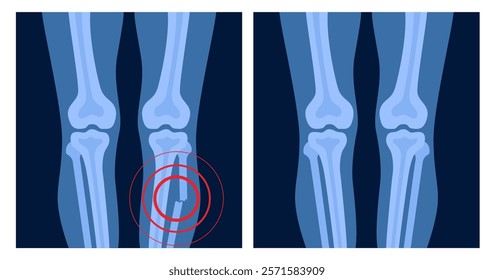 X ray of leg fracture with red pain point. Broken leg with open type of fracture. Human skeleton anatomy concept. Medical banner for clinic or hospital. Vector