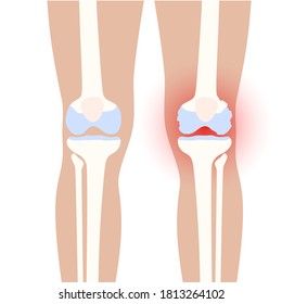 X ray of normal knee and arthritic joint. Rheumatoid arthritis disease. Human leg bone anatomy. Skeleton medical scan concept. Painful injury and erosion. Medical flat vector illustration for clinic.