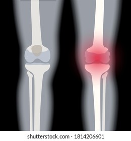 X ray of normal knee and arthritic joint. Rheumatoid arthritis disease. Human leg bone anatomy. Skeleton medical scan concept. Painful injury and erosion. Medical flat vector illustration for clinic.