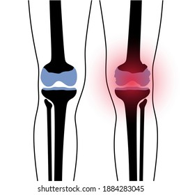 X ray of normal knee and arthritic joint. Rheumatoid arthritis disease. Human leg bone anatomy. Skeleton medical scan concept. Painful injury and erosion. Medical flat vector illustration for clinic.