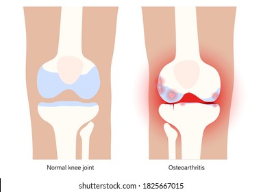 X ray of normal knee and pain in arthritic joint. Osteoarthritis disease. Human leg bone anatomy. Skeleton scan concept. Painful injury, erosion on medical poster. Flat vector illustration for clinic.