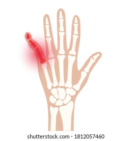 X ray scan with brocen finger. Fracture pain and inflammation in hand. Problem with joints and bones. Skeleton scanning concept. Arm disease flat vector illustration. Medical banner, poster for clinic