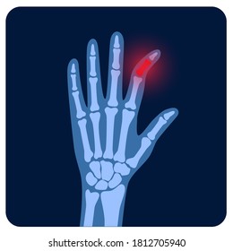 X ray scan with brocen finger. Fracture pain and inflammation in hand. Problem with joints and bones. Skeleton scanning concept. Arm disease flat vector illustration. Medical banner, poster for clinic