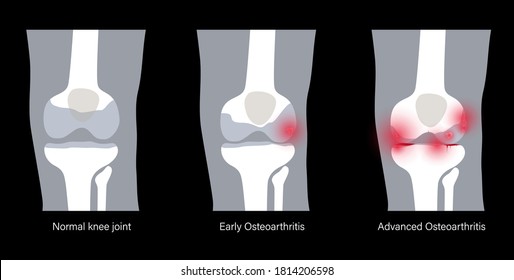 X Ray Stages Osteoarthritis Knee Joint Stock Vector (Royalty Free ...