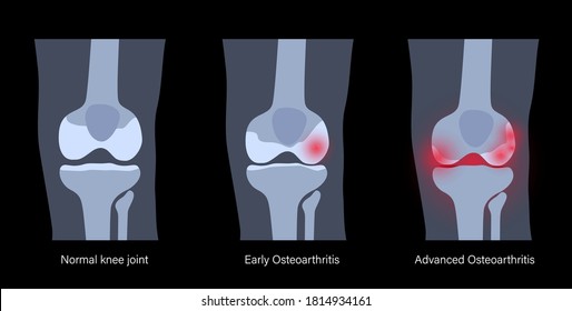 X Ray With Stages Of Osteoarthritis In Knee Joint. Arthritis Disease. Human Leg Bone Anatomy. Skeleton Scan Concept. Pain, Injury And Erosion On Medical Poster. Flat Vector Illustration For Clinic