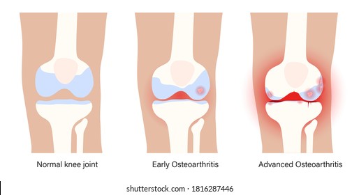 X Ray With Stages Of Osteoarthritis In Knee Joint. Arthritis Disease. Human Leg Bone Anatomy. Skeleton Scan Concept. Pain, Injury And Erosion On Medical Poster. Flat Vector Illustration For Clinic