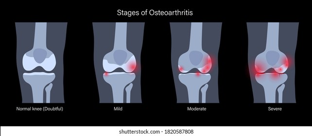 X ray with stages of osteoarthritis in knee joint. Arthritis disease. Human leg bone anatomy. Skeleton scan concept. Pain, injury and erosion on medical poster. Flat vector illustration for clinic