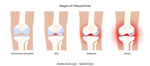 X ray with stages of osteoarthritis in knee joint. Arthritis disease. Human leg bone anatomy. Skeleton scan concept. Pain, injury and erosion on medical poster. Flat vector illustration for clinic