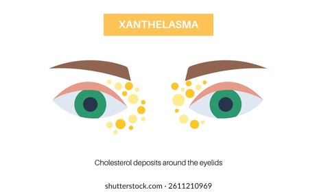 Xanthelasma around the eyes. Yellowish cholesterol rich plaques or deposits on eyelids. Skin diseases, dermatology and cardiology concept. Lipid disorder education flat vector illustration for clinic