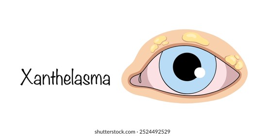 Xanthelasma. A cosmetic defect of the skin in the form of subcutaneous cholesterol deposits on the upper eyelid of a person. Isolated vector for different uses.