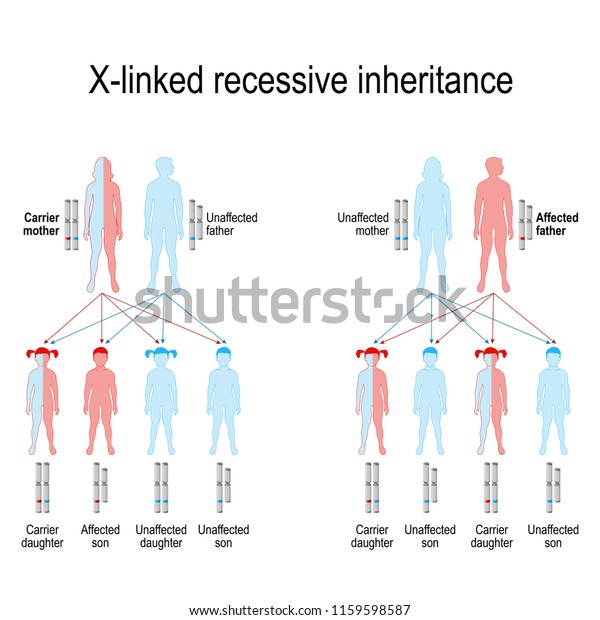 X連鎖劣性遺伝とは 形質や障害を引き起こす遺伝子がx染色体上に存在することを意味する 遺伝病 潜在的な結果を示すベクター画像 のベクター画像素材 ロイヤリティフリー