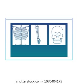 Xray bones images blue lines