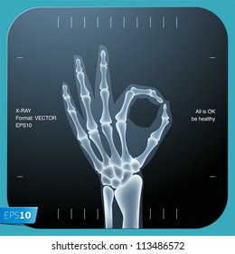 X-ray of both human hand (OK!), vector Eps 10 illustration.