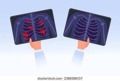 X-ray film of examine the lungs concept. Doctor examines CT scan to detect reason of chest pain, checking lungs disease. Two hands holding Xray image of healthy and unhealthy patient`s lungs vector