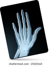 x-ray of hand