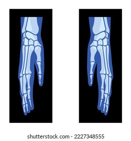 X-Ray Hands with Radius, Ulna Skeleton Human body, Bones adult people roentgen side view. 3D realistic flat blue color concept Vector illustration of medical anatomy isolated on black background