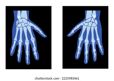 X-Ray Hands Skeleton Human body, Bones adult people roentgen back view - Metacarpals, Phalanges 3D realistic flat blue color concept Vector illustration of medical anatomy isolated on black background