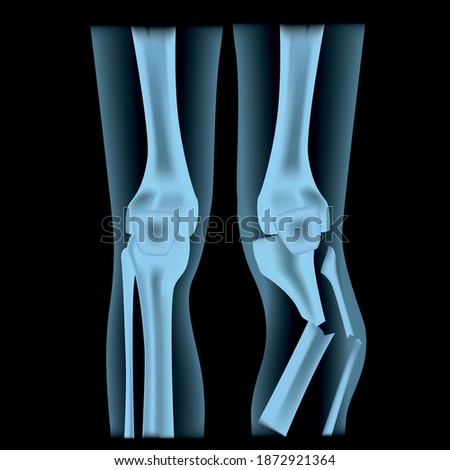 x-ray of human legs. Knee-joint. Open fracture with displacement. Vector illustration.