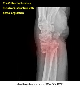 Xray image of colles fracture, broken hand