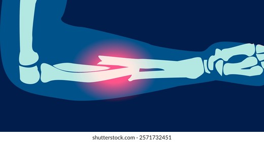 X-ray image of forearm fracture illustration. 2D rontgen picture of bone broken pain. Vector design.