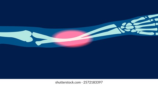 X-ray image of forearm fracture illustration. 2D illustration picture rontgen of forearm bone. Vector design.