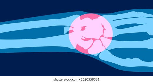 X-ray image of hand pain ilustration. 2D Picture rontgen of Hand bone in painful injury damage. Vector illustration