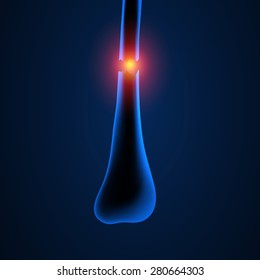 x-ray image show fracture both bone