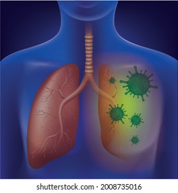 X-ray images of the lungs are missing one side by the virus.illustration vector