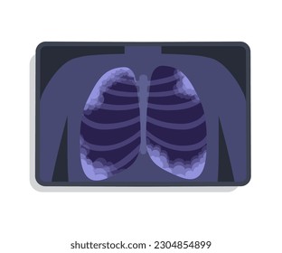 XRAY of Lungs Damaged by Pneumonia. Image of Acute Respiratory infection. Visualized by MRI or Scanner Inflammation of the Lungs. Chronic obstructive pulmonary disease vector flat illustration 