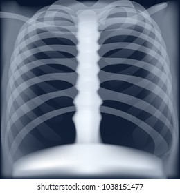 xray medical image of chest