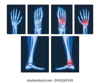 X-ray Pictures Of Hands And Legs Reveal Skeletal Structures, Joint Health, And Potential Abnormalities, Vector Set