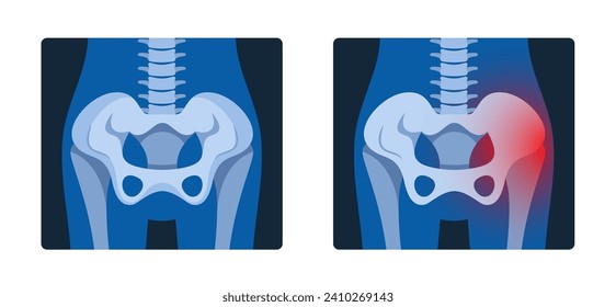 Las Fotos De Rayos X De Pelvis Proporcionan Imágenes Detalladas De Los Huesos De Hip, El Sacro Y La Ilustración De Coccyx, Vector