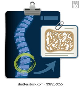 X-ray showing osteoporosis in vertebral column results, with fragile bone structure.