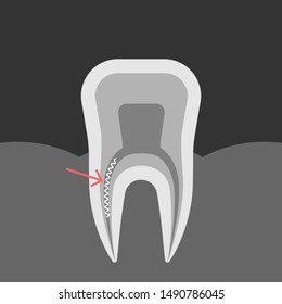 X-ray Of A Tooth With A Broken Forgotten Tool In Dental Root Canal. A Piece Of File Left In Root Cavity While Treating Pulpitis. Vector Illustration Of Xray Of Jaw.