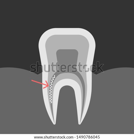 X-ray of a tooth with a broken forgotten tool in dental root canal. A piece of file left in root cavity while treating pulpitis. Vector illustration of xray of jaw.