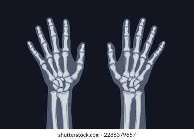 XRAY two hands with wrist and fingers