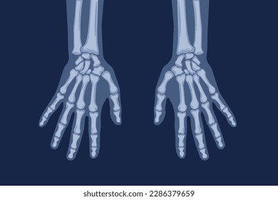 XRAY two hands with wrist and fingers