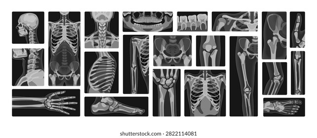X-rays set. Xray shots of different bones of human body. Diagnostics of fractures with roentgen rays. Radiology and radiography. Examination of skeleton. Black and white flat vector illustrations