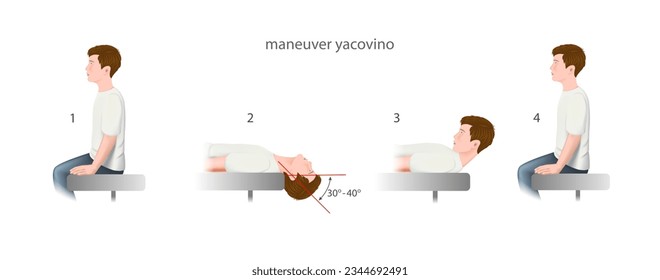 yacovino maneuver, a practical guide to the treatment of benign positional paroxysmal vertigo (bppv). Training manual, education.  Vector. 