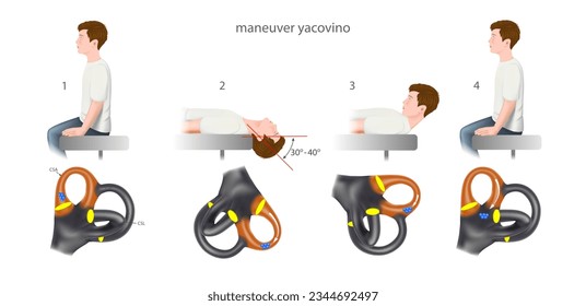 yacovino maneuver, a practical guide to the treatment of benign positional paroxysmal vertigo (bppv). Training manual, education. Diagram of the structure of the inner ear. Vector. 