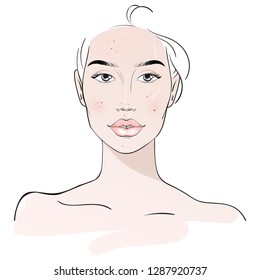 Yang woman with the rash and pimples  on the face. Spa beauty concept. Vector illustration. Hand drawn fashion illustration.