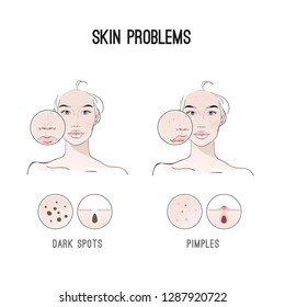 Yang woman with skin problem. Infographic of clogged nose pores, blackheads and acne. Vector illustration. 