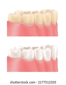 Yellow Dirty Teeth. Teeth Whitening. Treatment. Before and After. Clean Healthy Perfect Teeth. Side view. Color Realistic style. White background. Vector illustration for Medical and Dental Design.