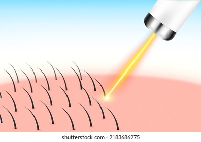 Yellow laser light hair removal unwanted out make skin smooth. Medical beauty concept. 3D Realistic vector EPS10.