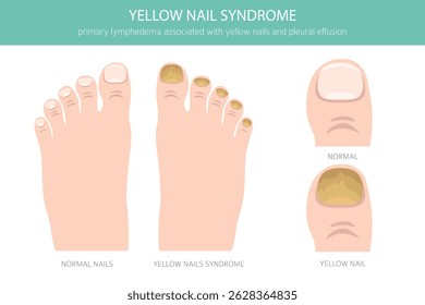 A Síndrome das Unhas Amarelas é uma condição rara marcada por unhas amarelas grossas e de crescimento lento, muitas vezes com linfedema e problemas respiratórios. Infográfico médico. Ilustração vetorial